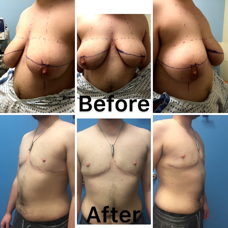 A, Breast appearance before transgender top surgery. B, Results
